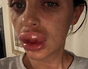 How to Avoid Going Overboard With Lip Injections
